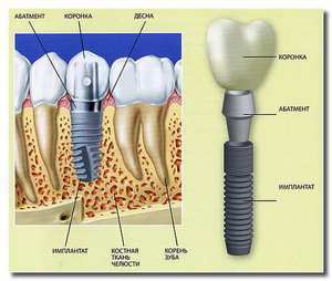 Installation of the implant