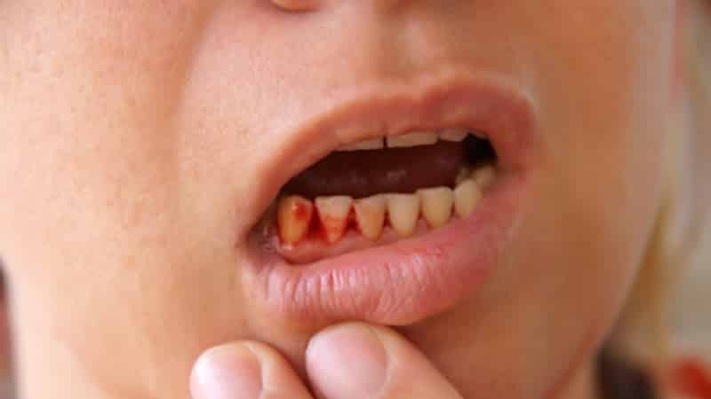 gewickelt zwischen dem Zahnfleisch und Wange
