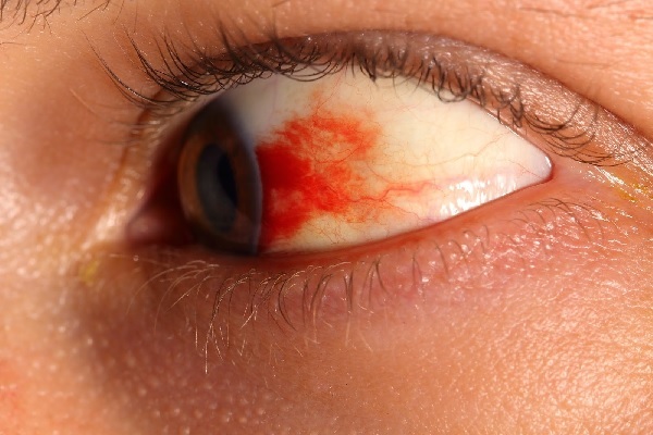 Krvácení do očí