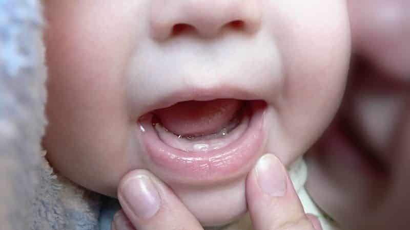 White pimples in the mouth of the child: photo of baby, watery and red