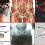 Los síntomas de la artrosis de las articulaciones de la cadera