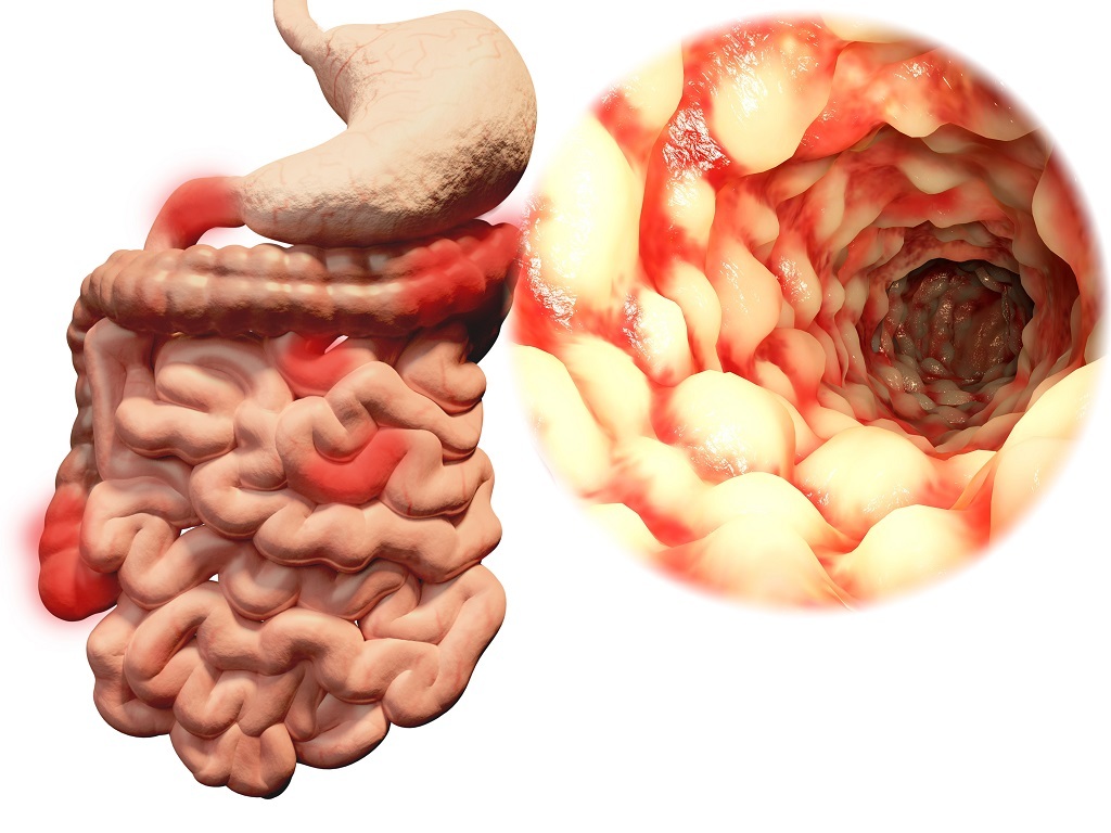 Maladie de Crohn: symptômes et traitement chez l'adulte