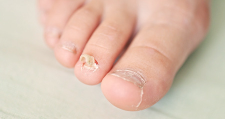 Vad är nagelsvampen och hur utvecklas den på nagelplattan
