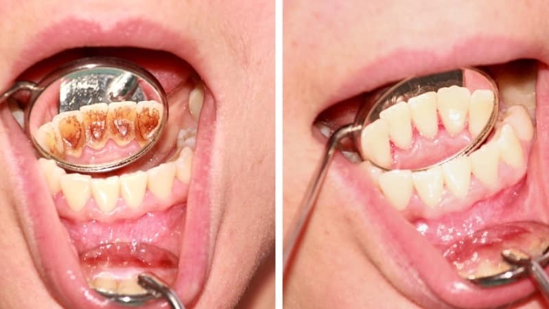 fjernelse af sten fra tænderne
