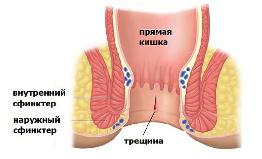Frattura della mucosa intestinale