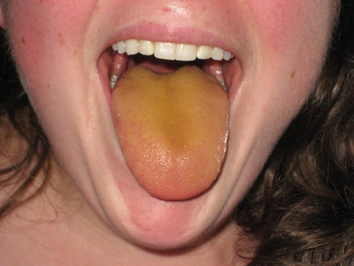 jaune plaque dans la langue