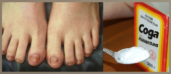 Soda de hongos en las uñas de los pies: instrucciones (recetas), revisiones