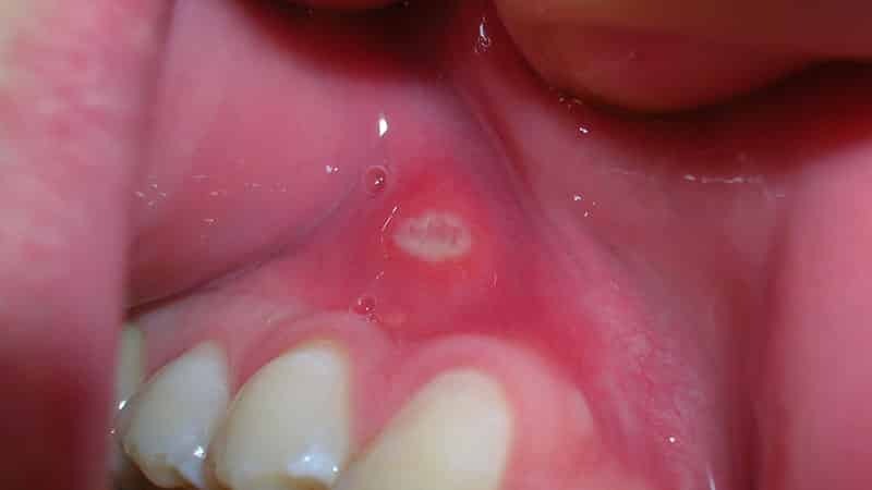 Wunden auf dem Zahnfleisch um den Zahn