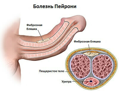La malattia di La Peyronie - sintomi e trattamento