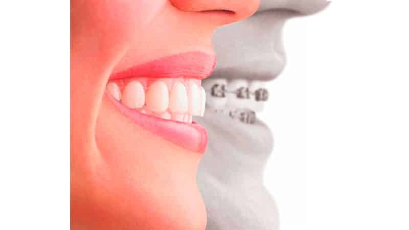 Ausrichtung der Zähne bei Erwachsenen