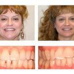 Korrektion dental malocclusion
