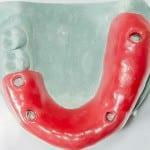 Anpassning av tänderna utan hängslen