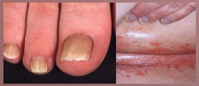 Lesões fúngicas da pele e unhas