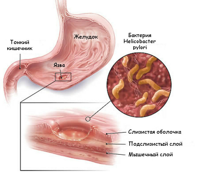 I primi sintomi e segni di un'ulcera dello stomaco