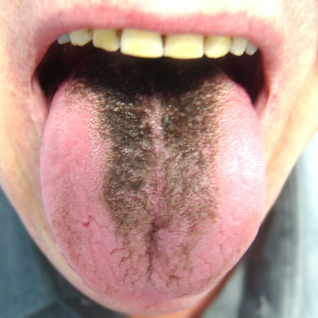Svart hårete tunge: hva er det, symptomer, bilder, behandling, prognose