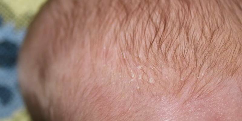 Hongo del cuero cabelludo - síntomas de la enfermedad, métodos de tratamiento y fotos