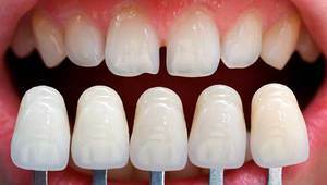 Description of the properties of non-removable dentures