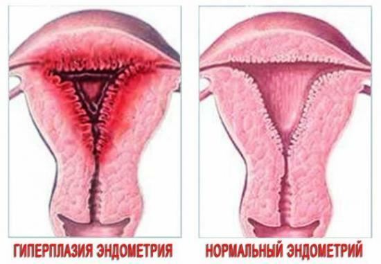 lobulär hyperplasi av endometrium lechenie4