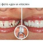 Installazione delle piastre ceramiche sui denti