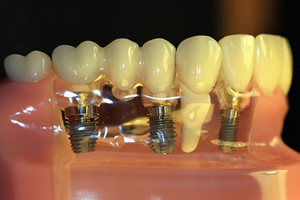 Vlastnosti a zubních implantátů instalační procedury