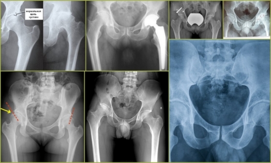 Manifestación de la cadera anomalías en la radiografía
