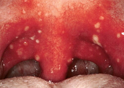 Herpes mal di gola
