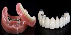 Types of dentures and their characteristics