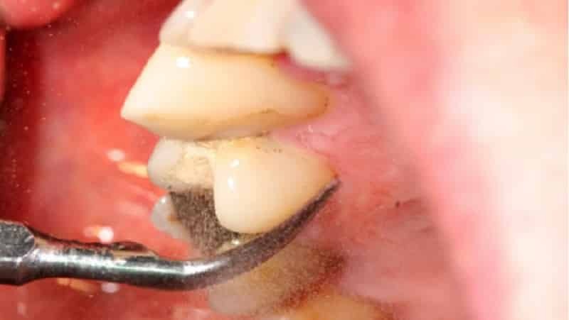 los dientes para blanquear los comentarios más seguros dentales