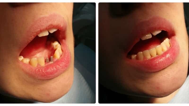 Vložte zub: kolik je zlatá přední zub