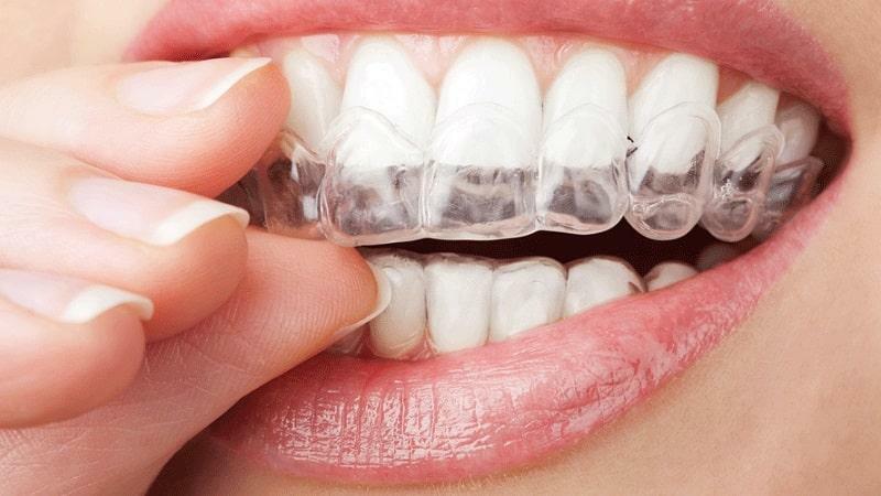 causas dientes amarillos