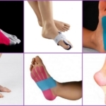 Fixing Fuß mit Osteophyten