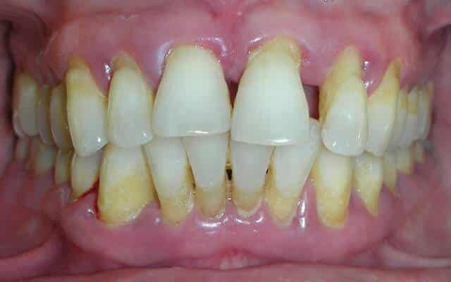 La enfermedad periodontal - foto 1