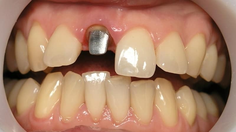 Tab in the tooth: what is it, photos, varieties