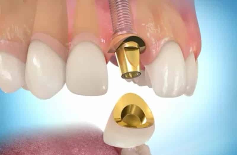 Jaký lepší vložit falešné zuby: Před Po