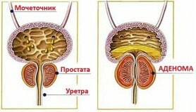 Årsager til urininkontinens hos mænd og klassificering