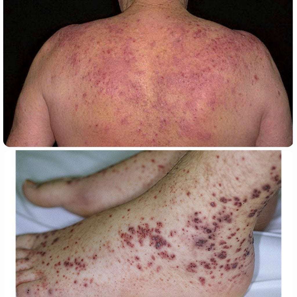 Maladie de Werlhof (purpura thrombocytopénique): qu'est-ce que c'est, symptômes et traitement