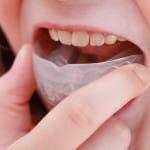 Korrigera tänder utan hängslen hos barn