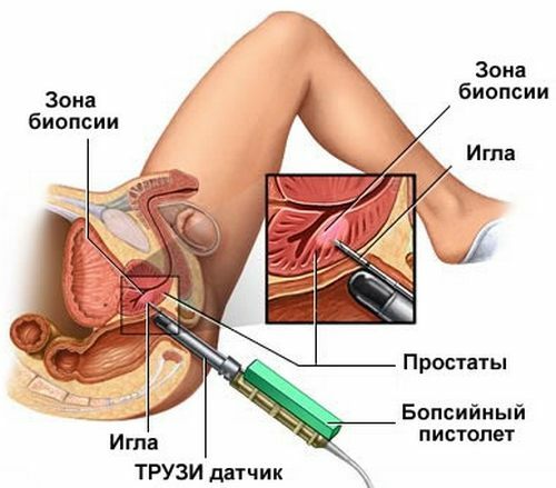 La ecografía transrectal( TRUS) de la próstata