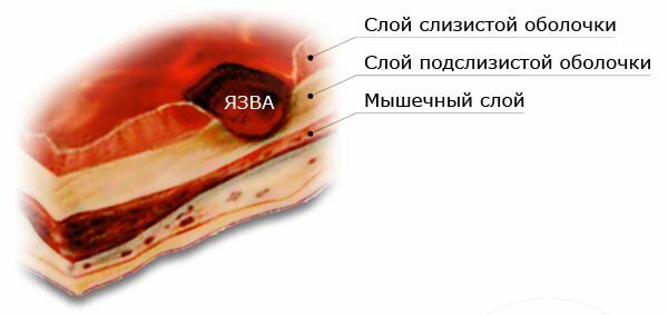595207 Estadísticas ulcerosa de la enfermedad del estómago-in-Kazajstán