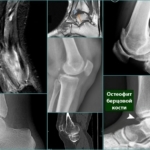 Osteophyt auf x-ray