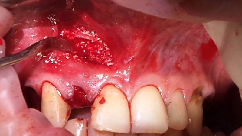 Blister auf dem Zahnfleisch, Was ist diese Blase und wie sie zu behandeln