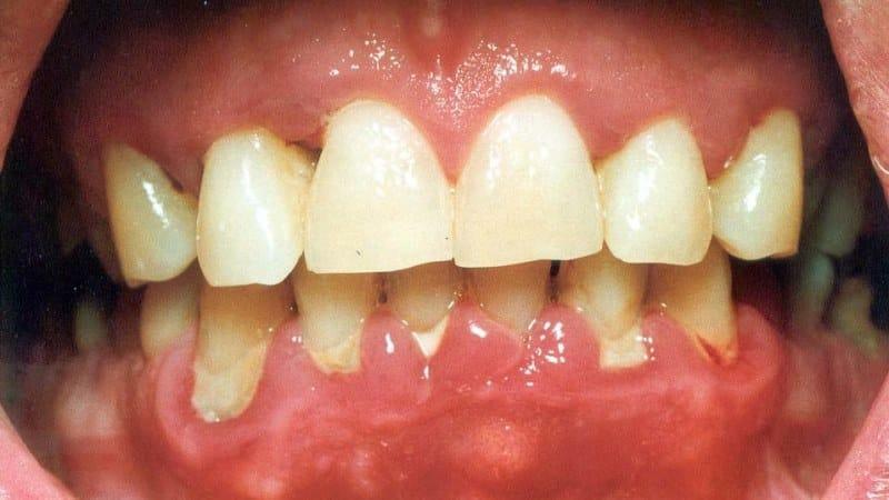 was zu tun ist, wenn ein Zahn aus dem Zahnfleisch als Belohnung verläßt