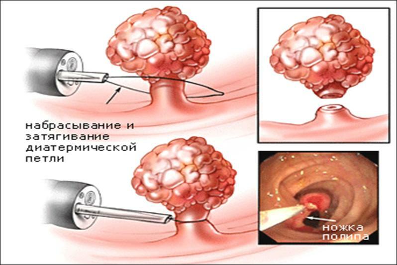 Tratamiento de los pólipos del colon sigmoide