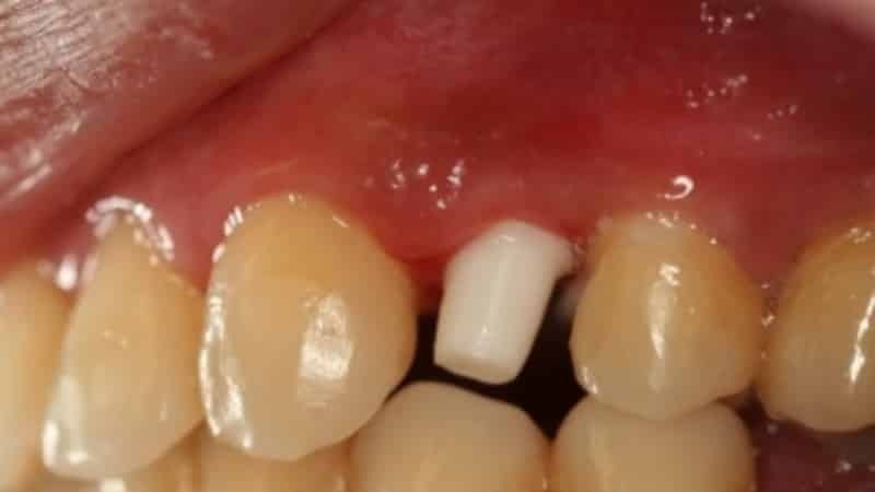 dentes de plástico dentes foto