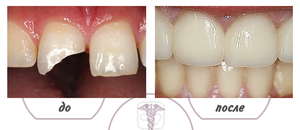 Il restauro dei denti anteriori: dispone di procedure metodi disponibili e fasi della procedura, prima e dopo la galleria