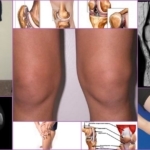 Chondromalacia patella och knä - manifestationer