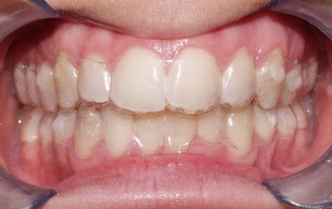 Miten yhdenmukaistaa hampaita aligners