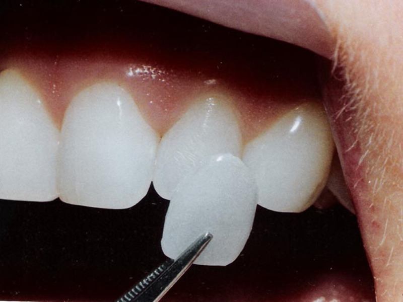 Како капацитет зуби