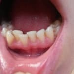 Ist es möglich, ohne Klammern auszurichten Zähne