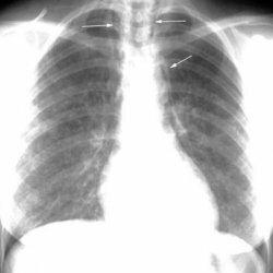Istiocitosi X dei polmoni. Cause, sintomi, trattamento